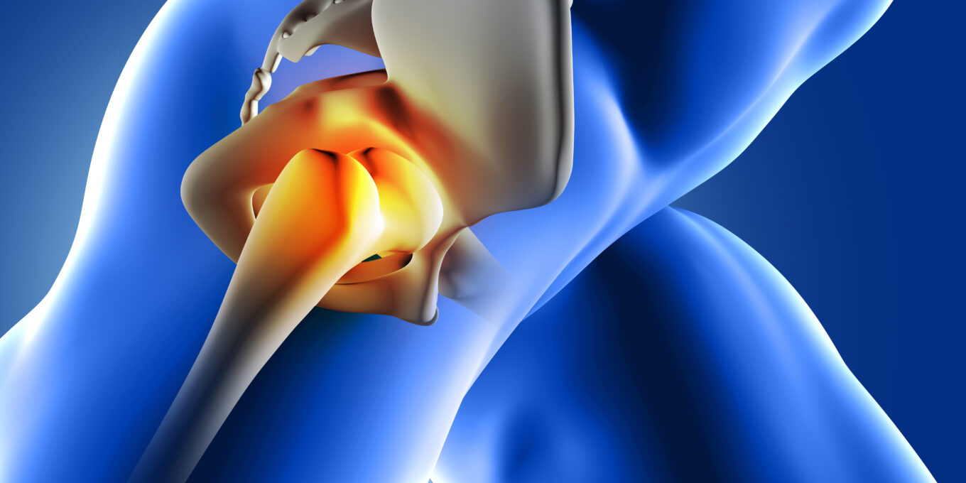 Approfondisci sulle fratture e protesi dell'anca